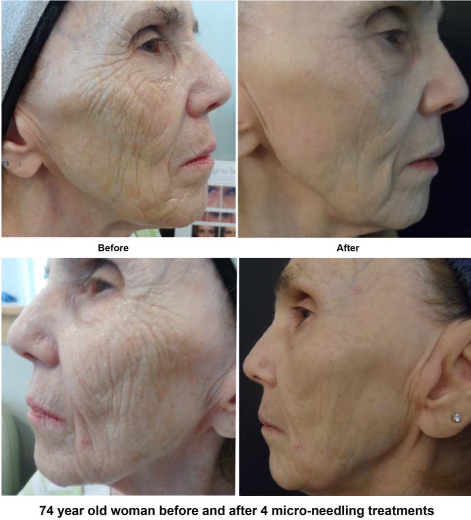 Before And After – 3 Treatments