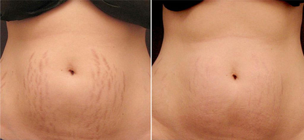 Before and After – Stretch Marks – 6 Treatments
