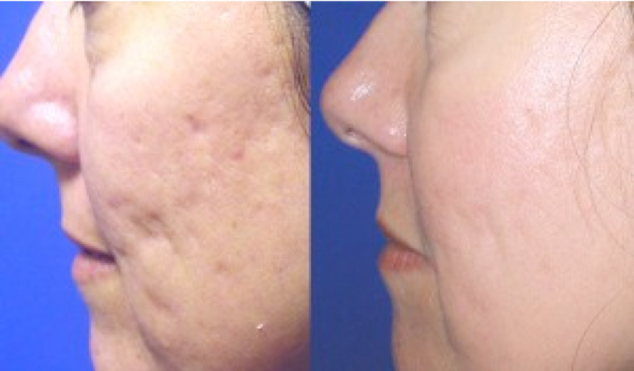 Before and After – Acne – 6 Treatments