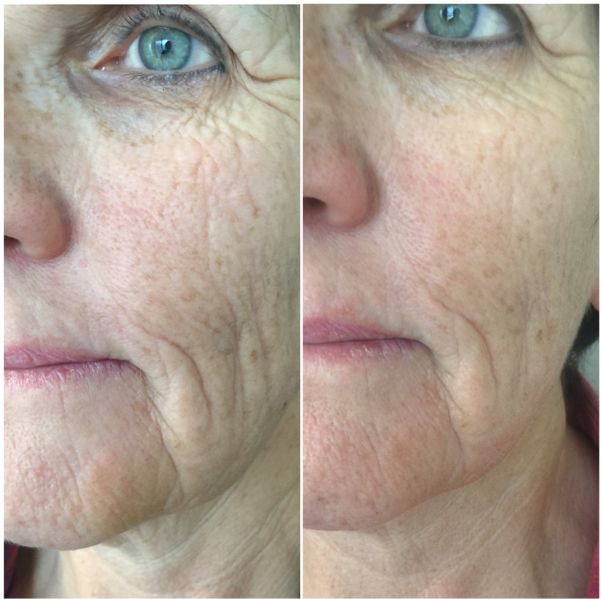 Before and; After – 2 Treatments 