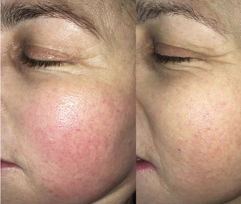 Before and After – Rosecea – 3 Treatment