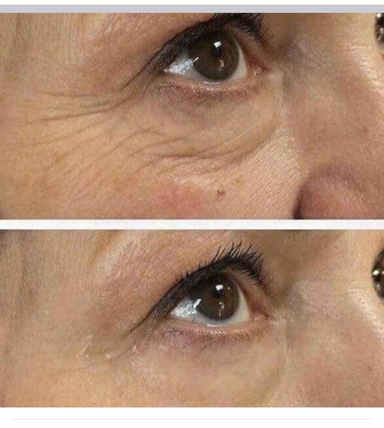 before and after Image wrinkles