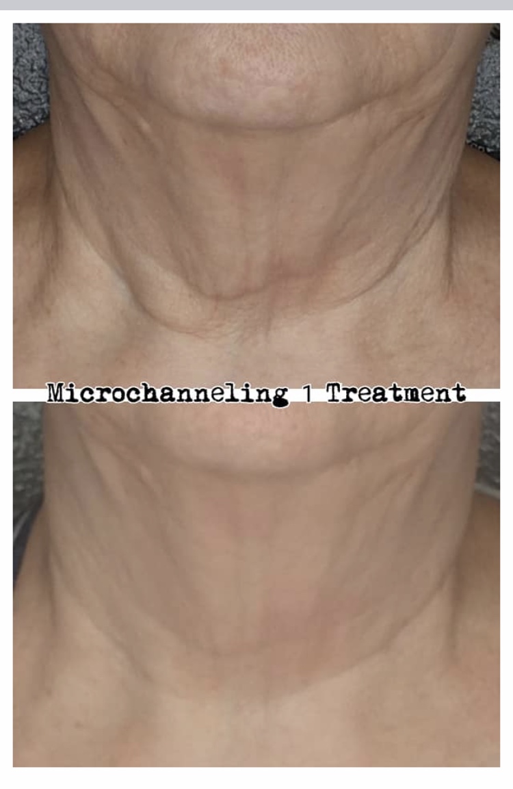 Before and After – Neck – 1 Treatment