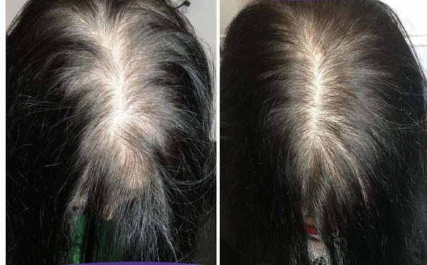 Before and After – Hair Regrowth – 3 Treatments