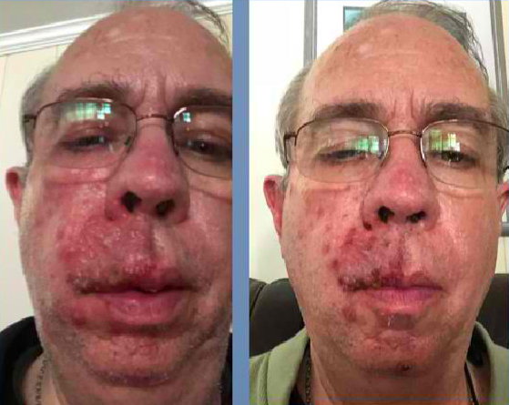 Shingles-Treatment